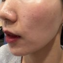 청주 피부관리 ㅣ 이츠제이 에서 물방울 하이푸 리프팅 받은 후기!