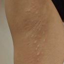 (주)다한디자인 | 미라드라이 후기 겨드랑이 땀 억제 시술 실비 가격 부작용