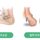 손목 아플 때 6가지 이유는? 찌릿 시큰 등 손목이 아파요 병원 이미지