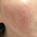 이종성피부과의원 | [주사피부염 일기] 수란트라 4일차 날치알 꺼져ㅠ