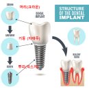 ㈜크라운종합건설 | [공지] 미사역임플란트, 39만원 임플란트 정말 괜찮을까요? <의사답변> (비용,가격)