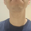삼가의원 | [내돈내산]위례 밴스의원 수염제모 중간후기