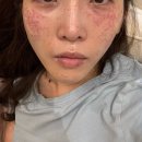 그린셀의원 | 추석연휴 주근깨털러 루나의원 방문후기(예약, 출근, 상담, 통증)