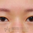 에이엠성형외과의원 네이버블로그