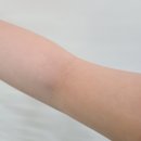 한결약국 | 콜린성 두드러기 약 약국 연고 치료 후기