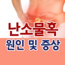 난소물혹증상 원인까지 함께 알아보자 이미지