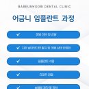 칠곡현대치과의원 | 대구칠곡치과 어금니 임플란트 단순히 심기만 하면 끝날까요?