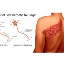 ■ 대상포진 후 신경통, 백신 접종시 80% 예방 이미지