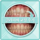 씨의원 | 클리피씨 교정 후기 입툭튀 덧니가 비발치로 해결된 기적