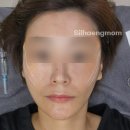 티나성형외과의원 | 실리프팅으로 피부 처짐 고민 해결 비용 및 후기