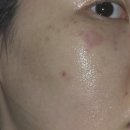 줌커피 | 주근깨 기미 잡티 레이저 피코슈어 토닝 + 레블라이트 + 줌패스 5 ~ 6회차 후기 (평택 고덕 피부과)