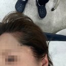 동안구청-7 | 강남구청 성형외과 에어젯 리프팅 후기 통증,효과,주의사항
