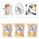 전방십자인대 파열이란?? 관절내시경을 통한 십자인대재건술 이미지