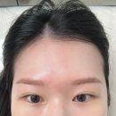 로뎀타워 | 마곡 눈썹 문신 제거 1회차 붉은잔흔 피딱지 없는 솔직 후기