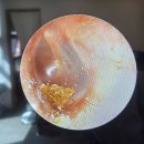 소리귀보청기 | 귀에서 바스락 소리가 들린다면? 이비인후과 귀지 제거 후기 [진심보청기 수원센터]