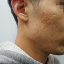 새로한의원 | 여드름흉터한의원 치료 과정 후기 새로 태어난 피부