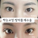 강남 쌍꺼풀 재수술 2개월차 리얼후기 : 짝눈교정 매몰재수술