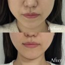 신탄진참좋은치과의원 | 강남 신사역 치과 레브치과 이갈이 보톡스 턱보톡스 내돈내산 후기