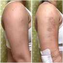 멍머리 | 인천 팔뚝 지방추출주사 일주일 붓기, 멍, 통증, 변화 후기