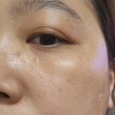제이스타피부과 멀티레이저 내돈내산 기미잡티제거 후기