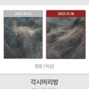 발모후기 사례