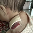 강북짐 | 강북삼성병원 혈관종입원 후기