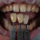 반듯한치과의원 | 왜소치 라미네이트. 열심히 교정치료 받은 나를 위한 선물. 비용/과정/후기.