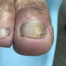 네일포시즌 레푸스 합정점 | 합정 문제성 발톱 케어 양쪽이 다른 문제로 고생하신 케이스