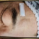 장미꽃과 나이팅게일 피부과의원 | [수원]장미꽃과 나이팅게일외과의원 이마 지방종 제거 후기