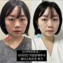 신사역피부과 브이라인 지방분해주사 “페이스하프컷” 후기