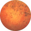 망막색소변성증(Retinitis Pigmentosa) 이미지