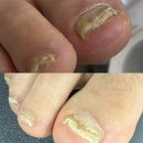 대전 전체 무좀발톱 케어 n개월 관리 전후 by 살롱원스&오로지푸스대전유성점