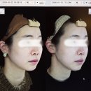 불근 | 여의도 피부과 추천 통증없는 무통 울쎄라 600샷, 팔자필러 후기