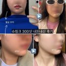 와썹멍 | 슈링크 300샷 내돈내산 후기 (전후사진, 붓기, 멍, 통증, 효과, 유지기간)