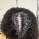 엘시티리턴의원 | 해운대 엘시티리턴의원 탈모약 한 달 후기 들고 왔습니다!