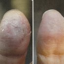 울산 무거동 해리스 뷰티 문제성피부관리 좋은 플라즈마, 물방울 관리 받은 후기