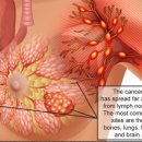 유방암 치료 과정 이미지