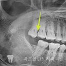 닥터오치과의원 | 사랑니 발치후 통증 무서워서 발치를 미루면? 중화동 치과