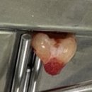 경산라온치과병원 | 포항 라온치과 매복 사랑니 발치 후기 🦷
