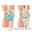 &#34;혈압약 베타 차단제, 퇴행성 관절염에도 효과&#34; 이미지