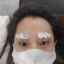 우당탕탕 문신제거;) 창원 눈썹문신제거 미시안피부과