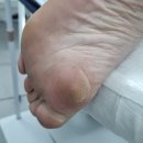 마포구발각질 관리 : 하이푸스 마포대흥점 문제성 발각질제거 후기