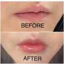 국산1로 | 명동 피부과 입술 국산필러 1cc 리얼후기 40대 입술 얇아짐 고민 끝! 볼륨 하나로 동안 완성