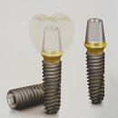 임플란트시술 임플란트수술 이란? - 임플란트과정 이미지