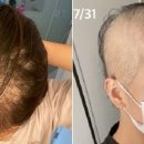 일본 20대 여성 “모더나 백신 맞고 한 달 만에 머리카락 다 빠져” 이미지