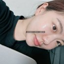 성수피부과 리프팅 올리지오 300샷 + 제네시스 레이저 후기 (통증, 효과)