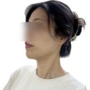 성수피부과 인모드후기 FX, FORMA 통증 차이 전후 비교