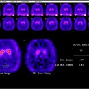 국시2차영상 Brain IPT spect 이미지