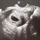 감자와눈사람여성의원 | [시험관/동결이식1차]포롤루텍스 품절/임신6주차 초음파 후기/감자와눈사람병원 후기