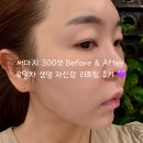 논현역 6번출구 뒤 | 강남 논현역피부과 써마지 300샷 후기 | 시술 1주일 만에 생얼 자신감 생긴 이유!